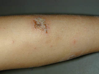 Блошиный дерматит у ребенка фото thumbnail