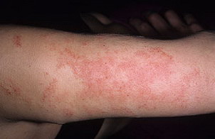 Аллергический дерматит лечение дерматология thumbnail